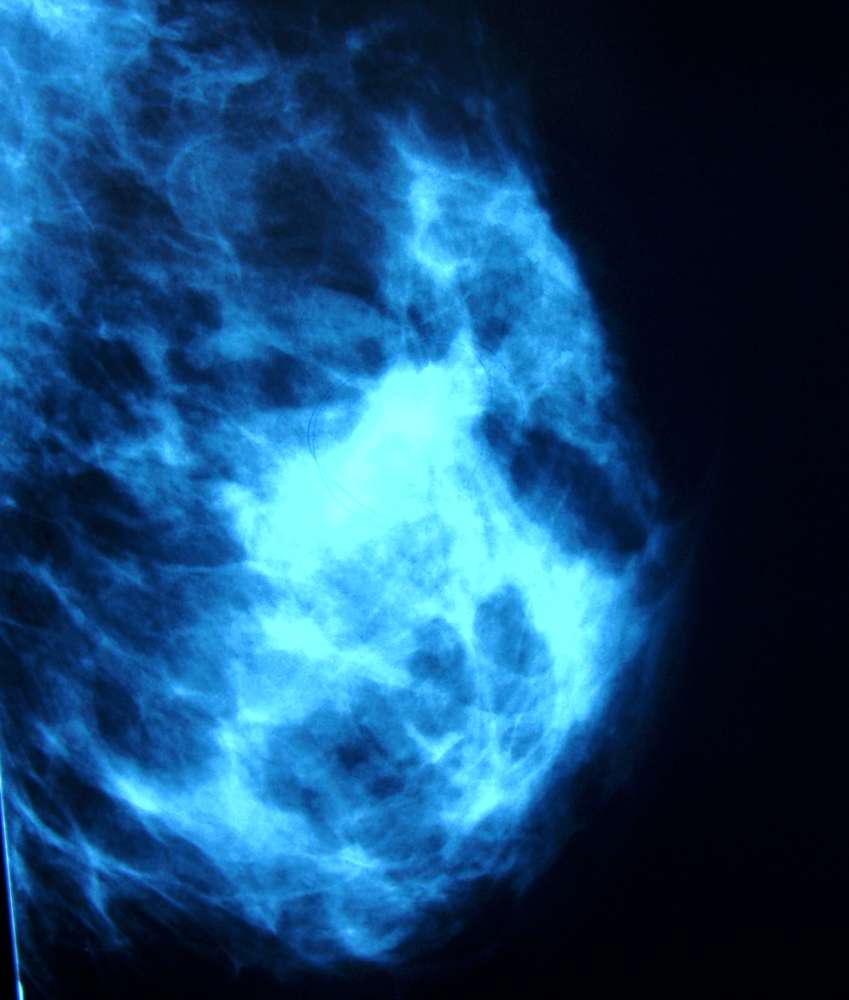 Core needle biopsy